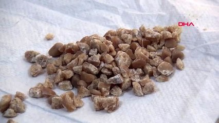 Niğde tek böbrekle yaşayan hastanın böbreğinden 100'e yakın taş çıktı