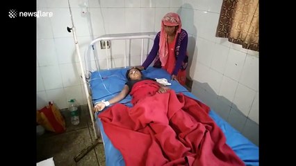 Doctors remove 3-kg hairball from stomach of 15-year-old girl in northern India