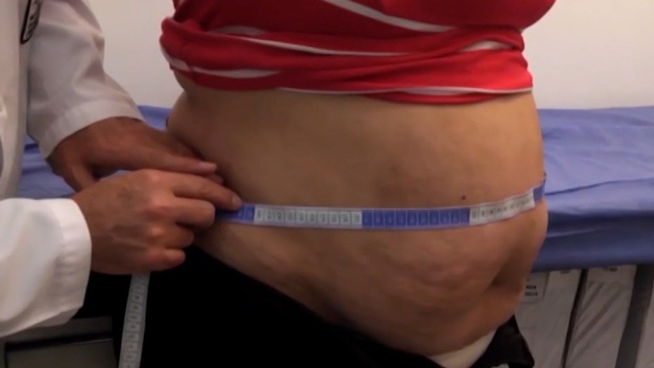 bd-obesidad-impacto-en-salud-040320