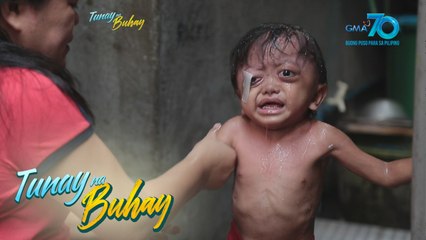 Tunay na Buhay: Tatlong taong gulang na bata, patuloy na lumalaban sa sakit na Langerhans Cells Hystiocytosis