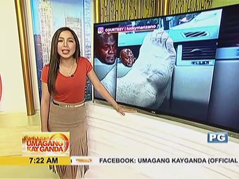 Luis Manzano, nagtamo ng fracture sa paa