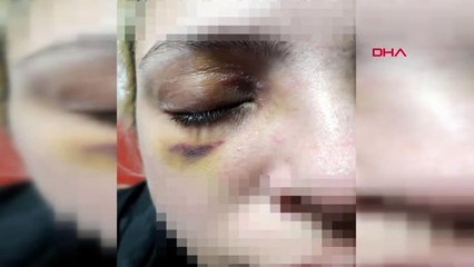 İZMİR Şizofreni hastasının gözlerini oymaya çalıştığı Burcu, saldırıyı anlattı