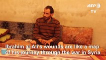 Tracing wounded body, one Syrian charts course of war