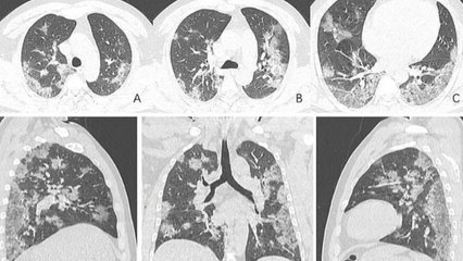 Découvrez à quoi ressemblent les poumons d'un patient décédé du coronavirus