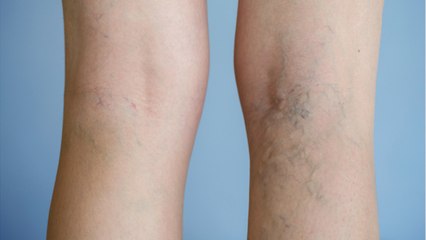 What You Should Know About Varicose Veins