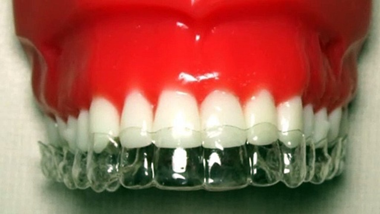 5 Key Benefits Of Invisalign