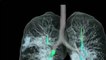 Coronavirus : Corona से प्रभावित Lungs की पहली 3D तस्वीर Viral | Coronavirus Lungs Image | Boldsky