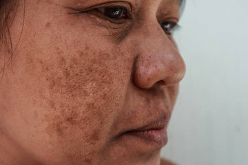 Dile adiós a las manchas con estos secretos naturales