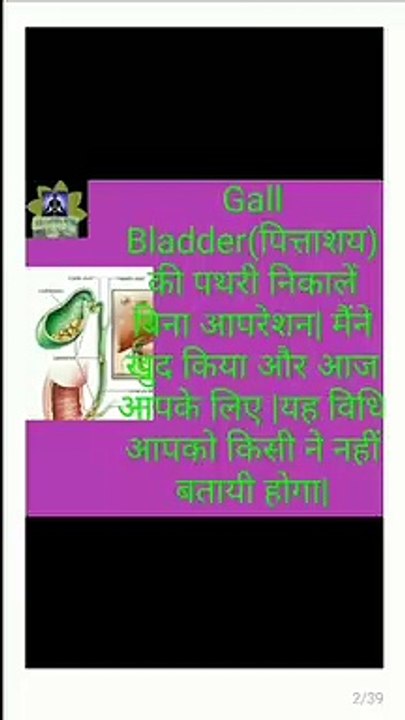 Gall Bladder Stone removal without surgery.Must Watch. इतना आसान तरीका