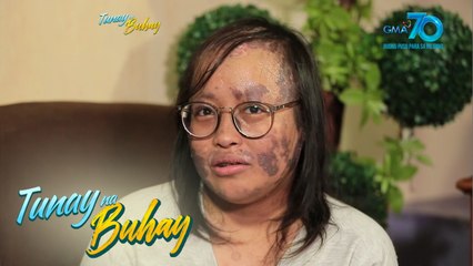 Tunay na Buhay: Dalagang may kakaibang sakit sa balat, gumastos ng halos P40,000 sa albularyo!