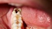 दांत के कीड़े खत्म करने का जबरदस्त इलाज | How to get rid of Tooth Worm | Boldsky