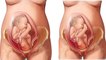 Pregnancy में गर्भ में बच्चा उल्टा हो तो करें ये काम | Breech Birth Causes &Complications | Boldsky