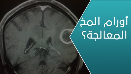ما خطورة إجراء عملية إزالة أحد أورام المخ ؟ - العيادة_2