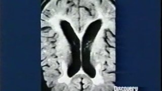 Cerebro: Amnesia y maquina corazon pulmon (CEC)