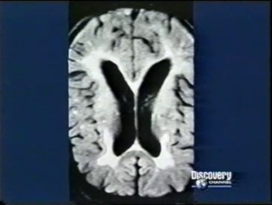 Cerebro: Amnesia y maquina corazon pulmon (CEC)