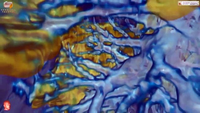 EXCLU - Virus : Découvrez pour la première fois en France les images 3D de la façon dont le virus attaque les poumons grâce aux images de l'hôpital George Washington University aux Etats-Unis