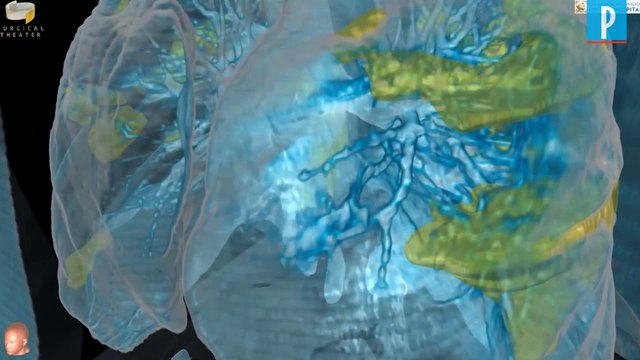Des poumons infectés par le coronavirus modélisés en 3D