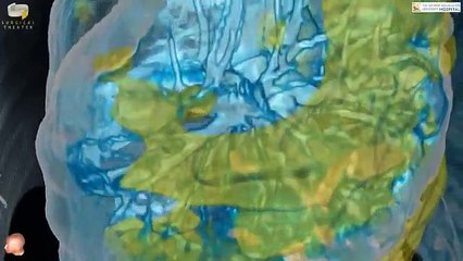 Koronavirüs, akciğerleri nasıl etkiliyor?