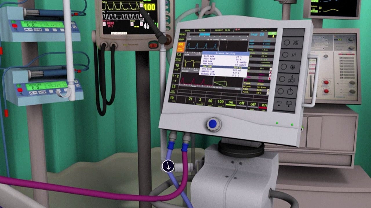 Videografik: So funktioniert ein Beatmungsgerät