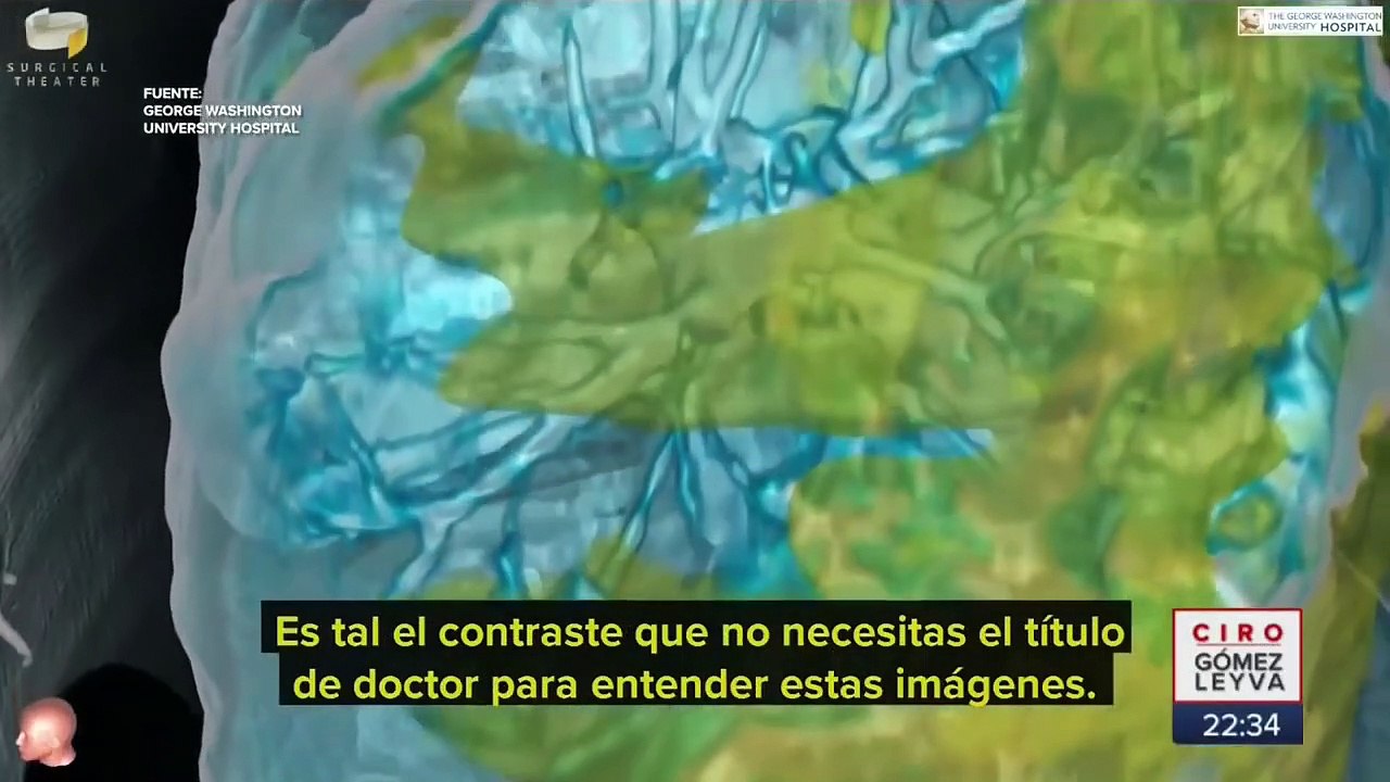 Así afectan los pulmones el Covid 19