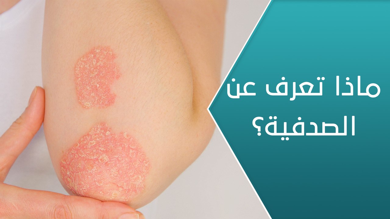 ماذا تعرف عن الصدفية؟ - العيادة