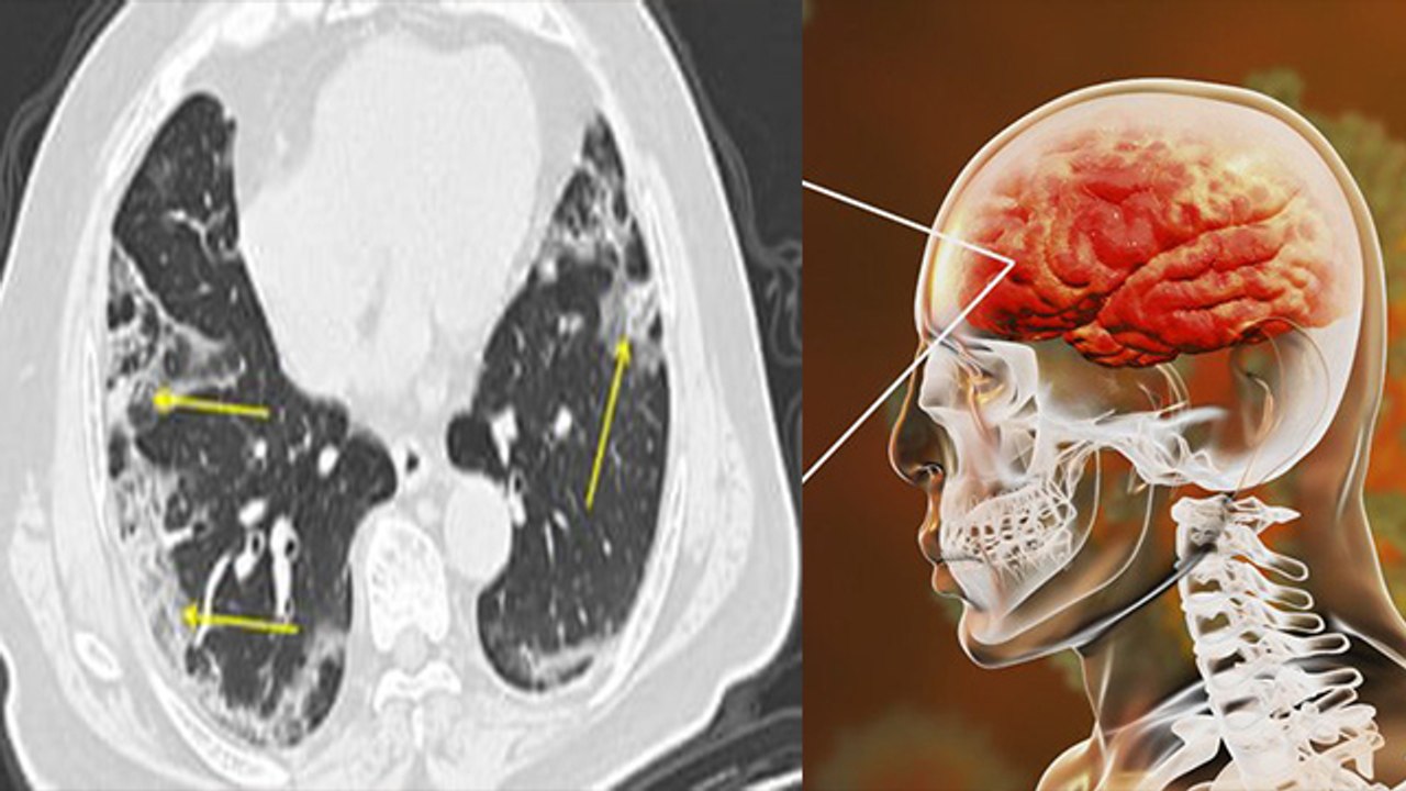 Brain को जकड़ने लगा है Virus, Patient खो रहे है बोलने की क्षमता । Boldsky