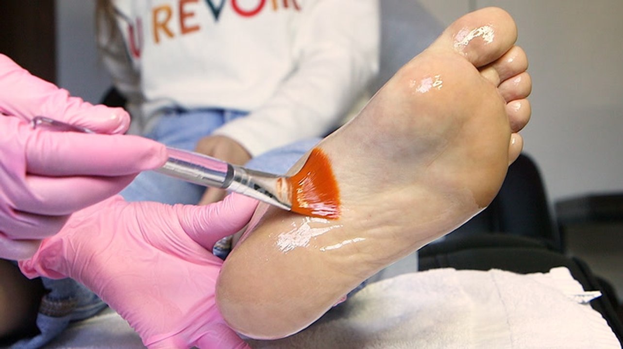 This chemical foot peel removes dead skin cell buildup through peeling