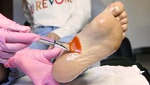 This chemical foot peel removes dead skin cell buildup through peeling calluses