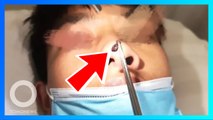 Hidung gatal, ternyata ada lintah 6 cm di dalamnya - TomoNews