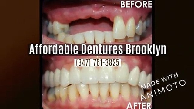 Affordable Dentures Brooklyn