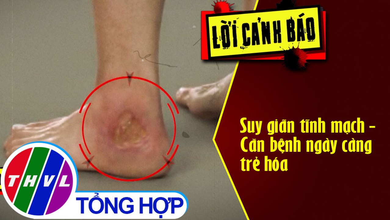 Suy giãn tĩnh mạch - Căn bệnh ngày càng trẻ hóa