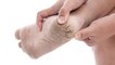 फटी एड़ी के लिए असरदार घरेलू उपचार | Cracked Heels Home Remedy | Boldsky