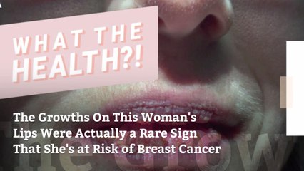 Download Video: The Growths On This Woman's Lips Were Actually a Rare Sign That She's at Risk of Breast Cancer