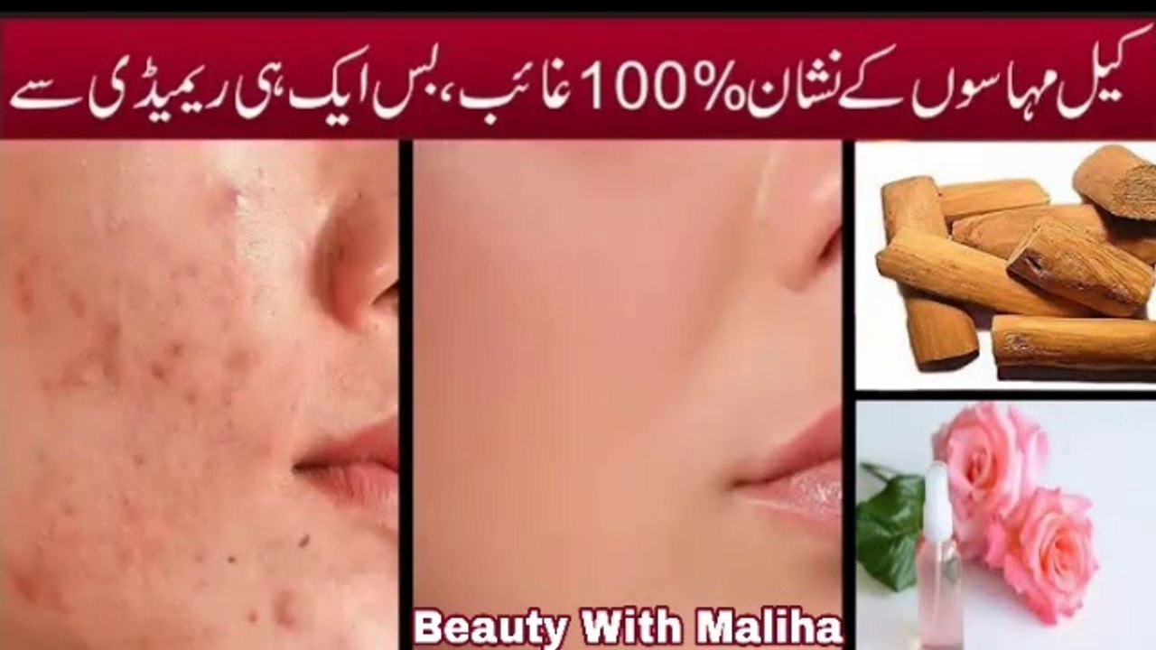 Acne spot removal treatment at home in urdu | Home remedy for acne spot | Beauty tips