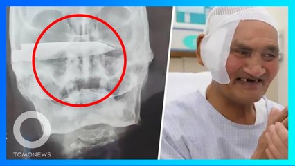 生鏽刀刃藏頭顱26年 醫生成功取出