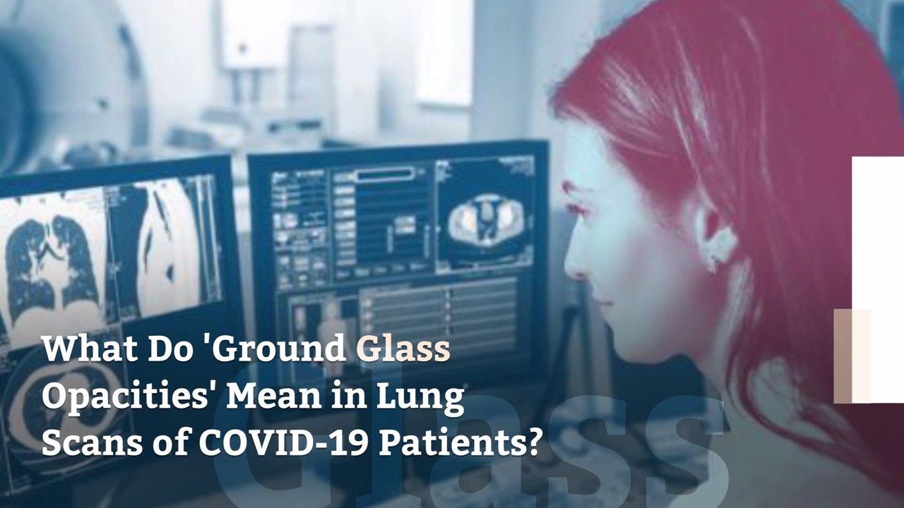 What Do 'Ground Glass Opacities' Mean in Lung Scans of COVID19