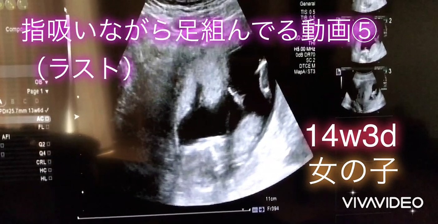 【ultrasonic diagnostics】A baby sucks her finger while crossing her legs ⑤☆pregnancy,fetus