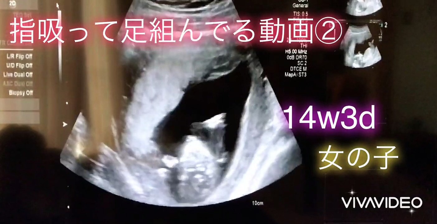 【ultrasonic diagnostics】A baby sucks her finger while crossing her legs ①☆pregnancy,fetus