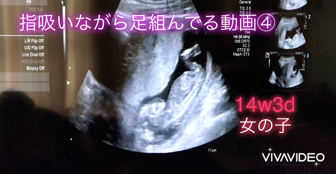 【ultrasonic diagnostics】A baby sucks her finger while crossing her legs ④☆pregnancy,fetus