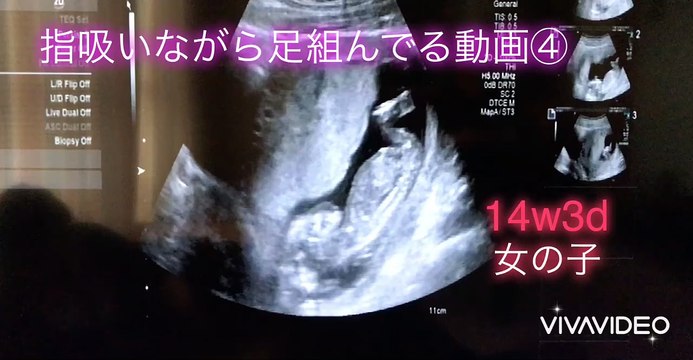 【ultrasonic diagnostics】A baby sucks her finger while crossing her legs ④☆pregnancy,fetus