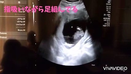 【ultrasonic diagnostics】A baby sucks her finger while crossing her legs ①☆pregnancy,fetus