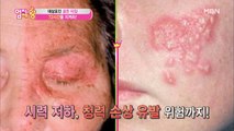 대상포진은 전염될 수 있다?! 골든타임을 지켜라! 대상포진 바로 알기