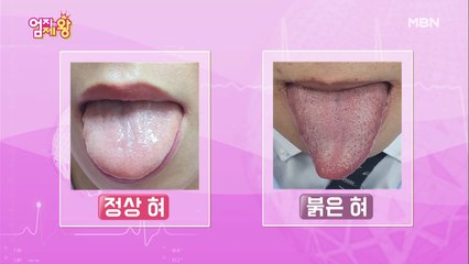 얼굴과 혀를 보면 뇌 독소가 보인다? 뇌 건강 [자가 진단법]