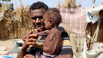 الأمم المتحدة: 75 مليون طفل يواجهون مشكلات صحية بسبب الجوع