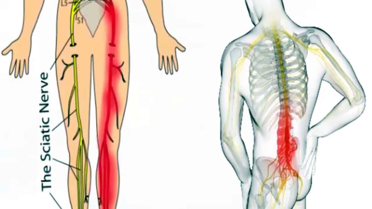 CÓMO CURAR LA CIÁTICA CON UN PAR DE HUEVOS! REMEDIO CASERO NATURAL QUE NO FALLA! EL MÁS IMPORTANTE!