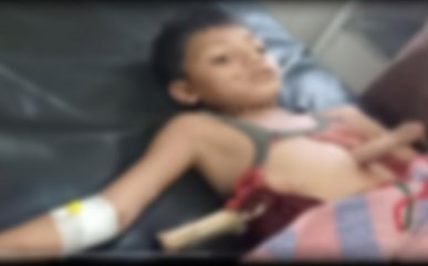 बच्‍चे के पेट के आर पार हो गई लकड़ी