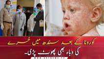 Sindh fears outbreak of measles amid coronavirus