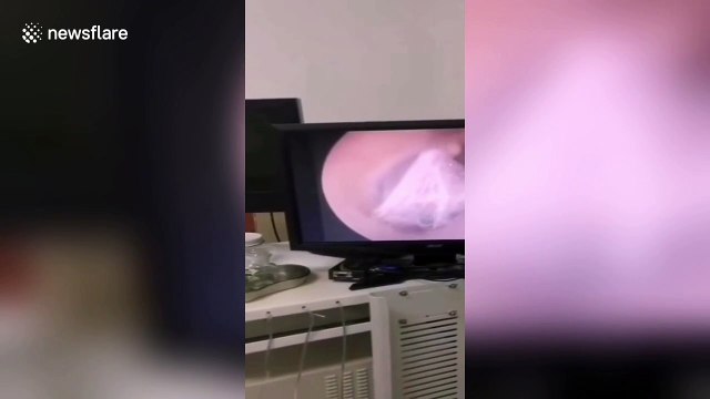 Chinese doctor removes spider that was weaving webs in woman's ear