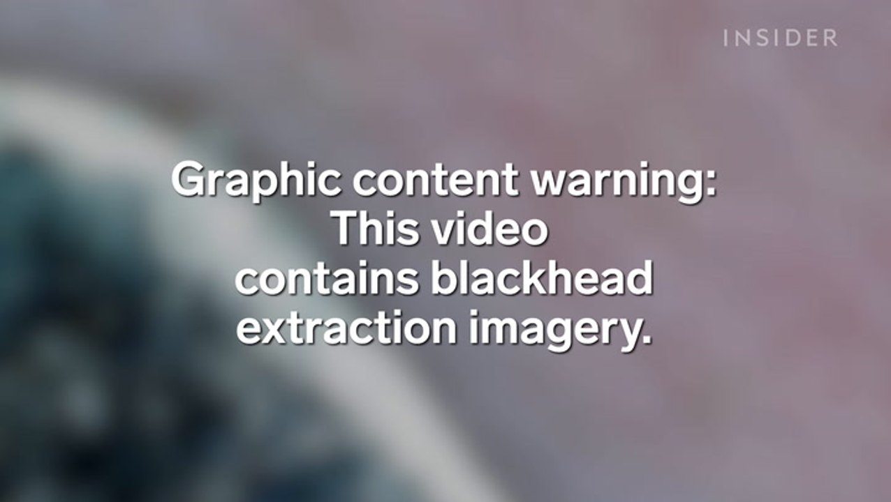 Watch a pore spatula do blackhead extractions under a microscope