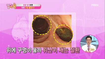 [서재걸의 인체교실]위염 방치하면 위에 구멍이 뚫린다?!